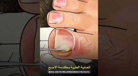 العناية الطبية شخص مصاب كدمة بالاصبع#medicine #طب #medical #علي_الطائي #healthy #هل_تعلم #doctor