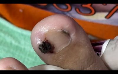 Ep_6585 *Ingrown toenail removal 