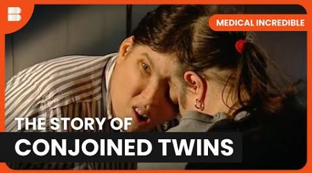 Living as a Conjoined Twin - Medical Incredible - Documentary