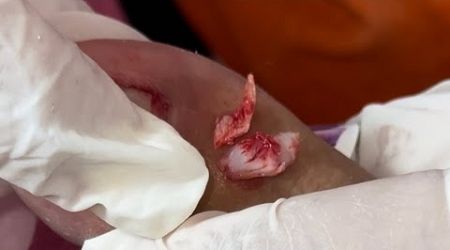 Ep_6575 Ingrown toenail removal 