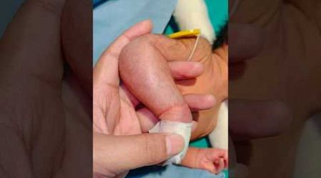 Newborn Hand Absess#baby #medical #viralvideo