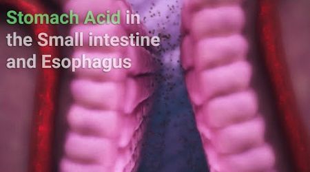 Stomach Acid in the Small intestine and Esophagus