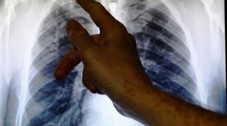 Indonesia ramps up fight against tuberculosis amid concerns on economic impact