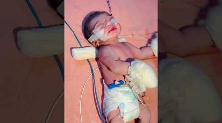 Birth Asphyxia Baby#nicu #baby #medical #viral