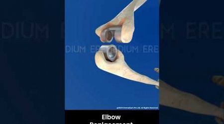 Total Elbow Replacement ↪ 3D Medical Animation #Shorts #ElbowReplacement #Elbow #Surgery