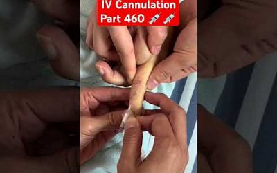 IV Cannulation | Part 460 | ICU #shorts #viralvideo #youtubeshorts #hospital #medical