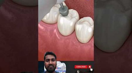 Dental Restoration ↪️ Composite Bonding Teeth ↪️ 3D Medical Animation