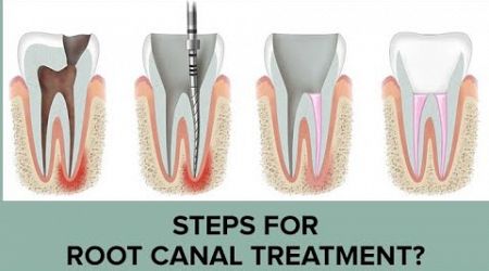 How to RCT Root canal Treatment||#dentist #medical#information_technology