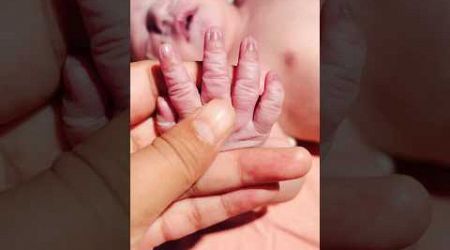 1days Baby’s Nail#nicu #medical #viral