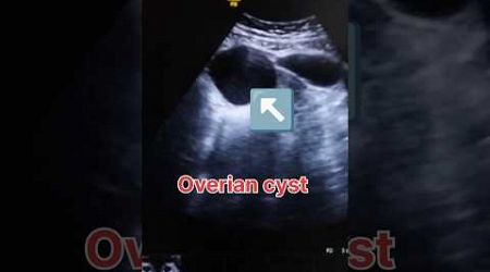 Right overian cyst ultrasound showing video #medical #cyst #shorts #medical_masti #ultrasound #baby