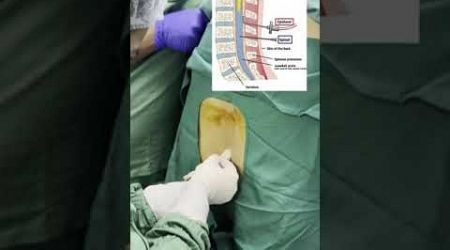 How spinal Anesthesia procedure is performed in Surgery #doctor #mbbs #neet #medical #anesthesia