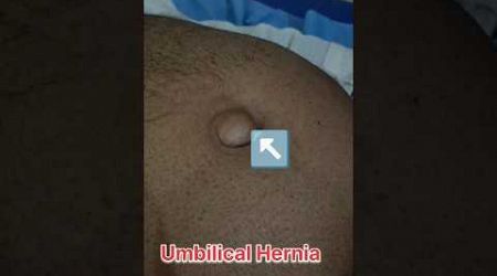 Umbilical Hernia |Umbilical hernia showing video | #pregnant #ultrasound #medical #baby #shorts #usg