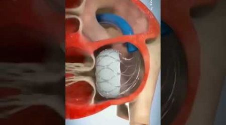 animated valve replacement #mitral #heart #anatomy_physiology #medical #animations #3danimation