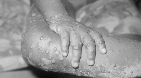 New mpox outbreak raises alarm; WHO considers declaring international emergency