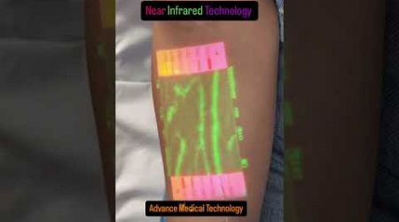 #trending | Advance technology in the medical field - Now it&#39;s easy to find your veins 