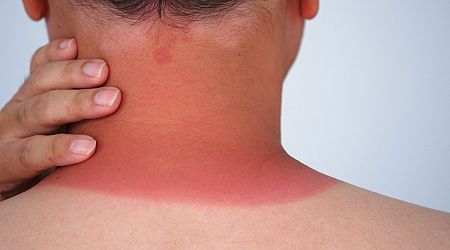 Why the Sunburns-for-Acne TikTok Trend Is So Stupid