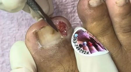 Ep_6972 Ingrown toenail removal 