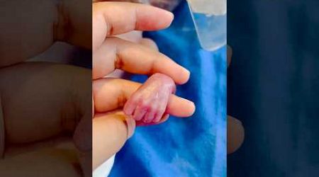 600 gm Baby Hand #medical #nicu #viralvideo