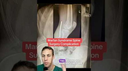 Rare spine surgery complication causes knee pain in Marfan Syndrome patient