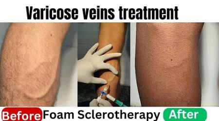 Result of foam Sclerotherapy| Varicose veins treatment for SSC GD medical test #varicosevein