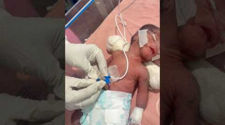 After Birth Cord Clamping#medical #newbornbaby #viralvideo