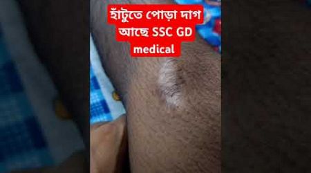 হাঁটুতে পোড়া দাগ আছে SSC GD medical #crpf medical