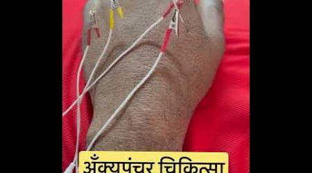 Accupuncture treatment for paralysis brain stroke ! Best Neurorehablitation center in nashik#health