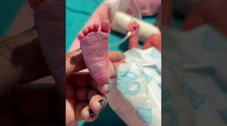 Little Leg#medical #newbornbaby #viralvideo