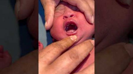 Oral Conginatal Defeats #medical #newbornbaby #viralvideo