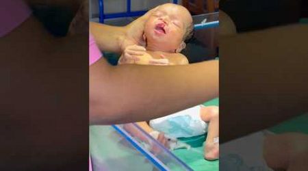 Cleft Lip Baby Feeding #medical #newbornbaby #viralvideo