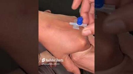 IV Cannulation procedure #ytshorts #shorts #viral #cannulation #intravenous #norcet#nursing#neet