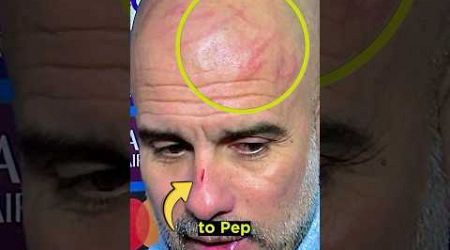 What happened to Pep Guardiola’s face?