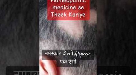 Alopecia की Best Homeopathic Medicine | @Drkirtivikramsingh