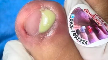 Ep_7235 Ingrown toenail removal 