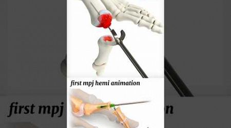 first mpj hemi animation #medical #animation #3d #animation | BiologywithAliya