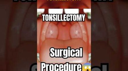 Tonsils Removal