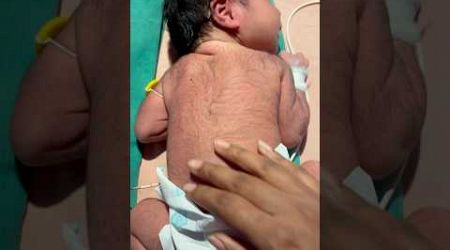 Hairy Newborn #medical #viralvideo