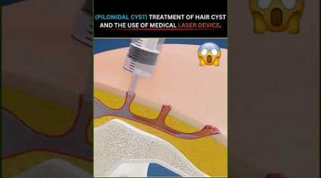 Treatment for Pilonidal Cysts: How Medical Lasers are Changing the Game!