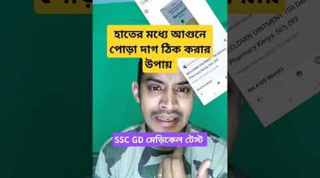 হাতের মধ্যে আগুনে পোড়া দাগ ঠিক করার উপায় #ssc GD medical test bsf