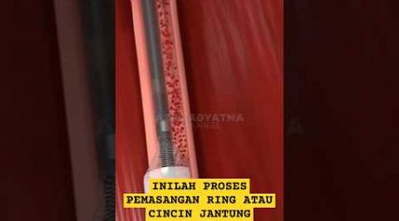 Proses pasang ring atau cincin jantung #medicine #jantung #health #sehat #shorts