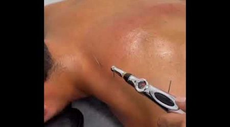 Acupuncture...does it work 