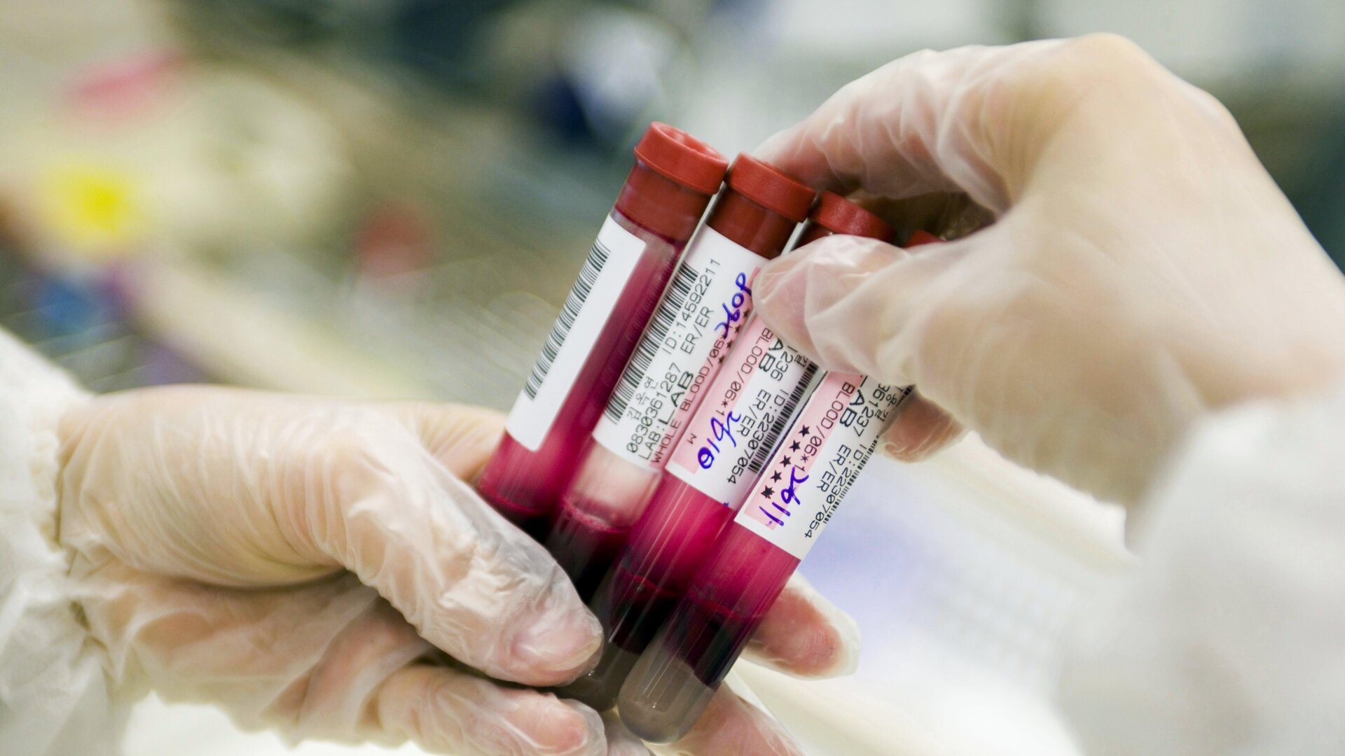 Blood Test Shows Promise for Alzheimer’s Diagnosis